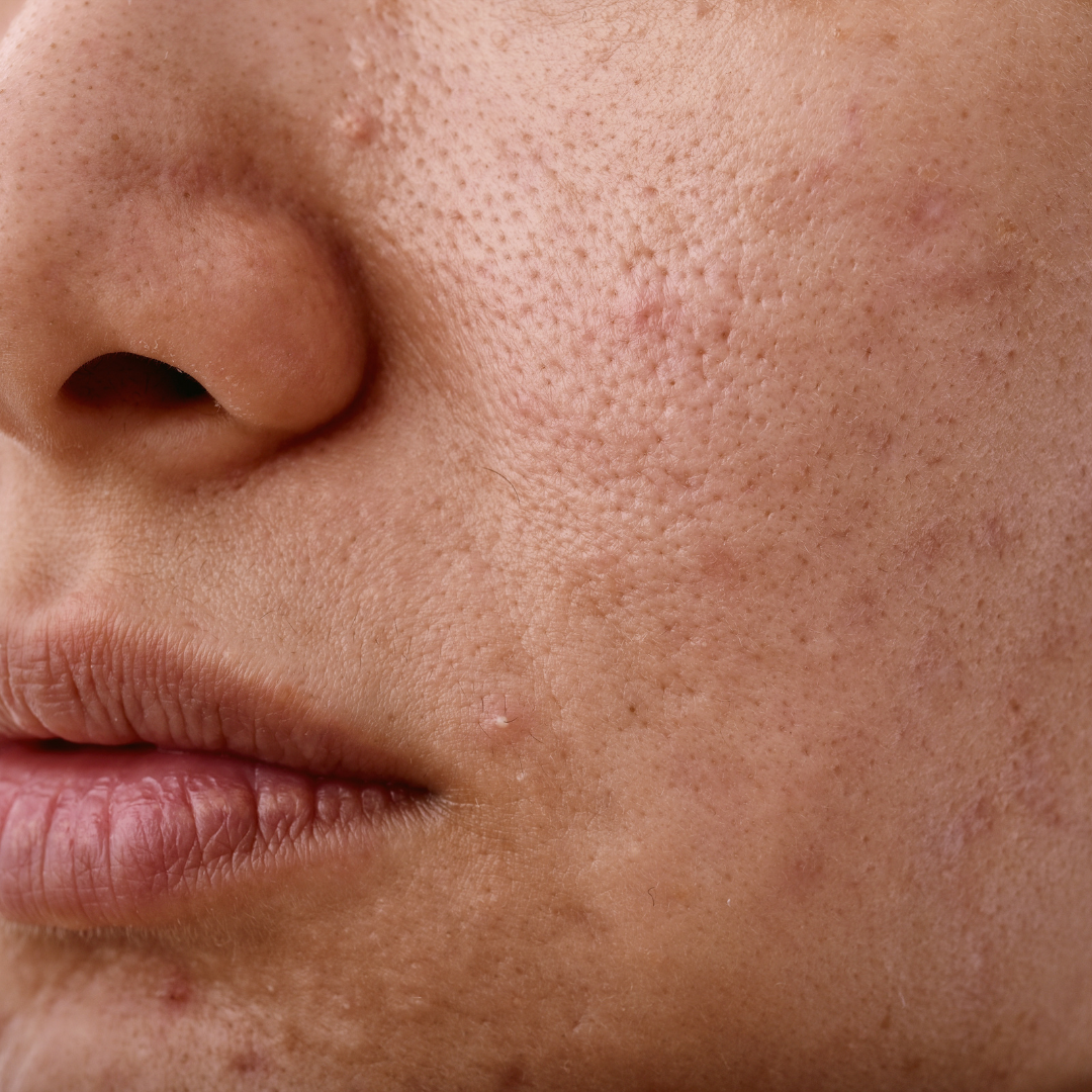 peau réactive stress émotionnel